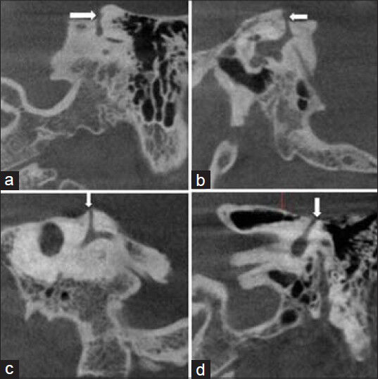 35-year-old male patient with clinical history of vertigo and autophony diagnosed with left superior semicircular canal dehiscence. CBCT of temporal bone (a and d) coronal (b) sagittal (c) oblique sagittal images show a dehiscence of the left superior semicircular canal (white arrow).