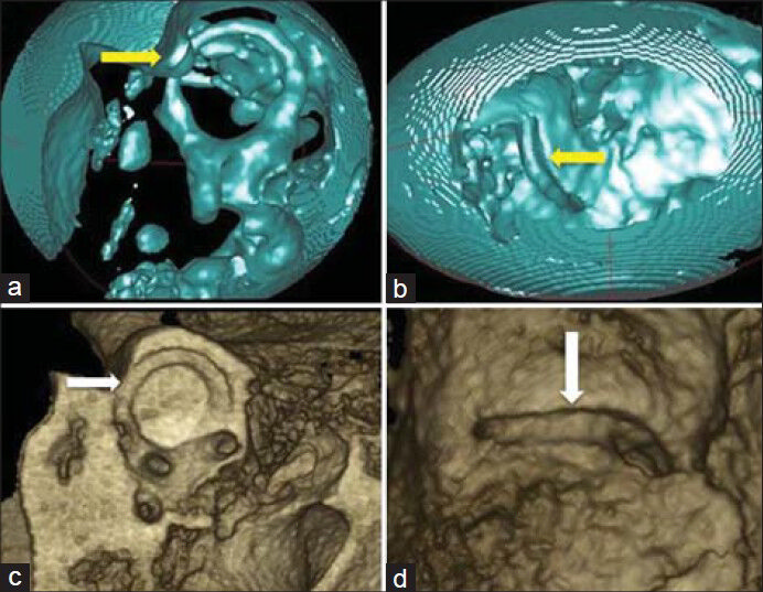 17-year-old patient with clinic history of progressive hearing loss, without vertigo and oscillopsia diagnosed with sensorineural hearing loss and right superior semicircular canal dehiscence. CBCT of temporal bone, air cavity volume rendering (green) images (a) sagittal view, (b) endocranial view, (c) osseous volume rendering oblique sagittal view and (d) osseous volume rendering superior view show superior semicircular canal dehiscence (yellow arrow in a), (yellow arrow in b), (white arrow in c), and (white arrow in d).