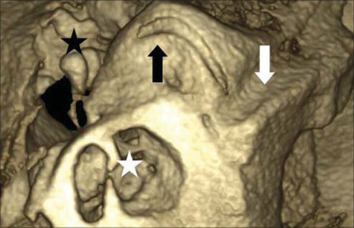 42-year-old male patient, with clinical history of cranial trauma and initial diagnosis of left temporal bone fracture diagnosed with left temporal bone fracture and ipsilateral superior semicircular canal dehiscence. CBCT of temporal bone shows incidental find of dehiscence of the superior semicircular canal (black arrow) in superior petrosal sinus canal area (white arrow), cochlea (white star), and ossicle chain (black star).