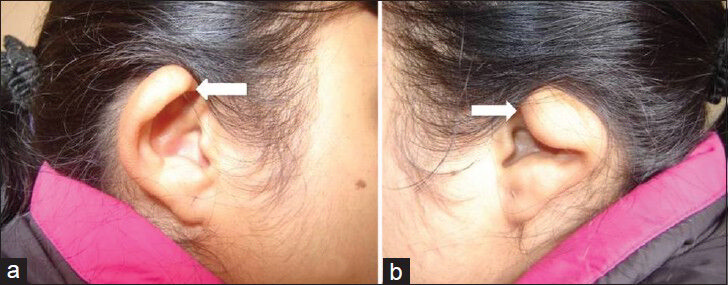 27-year-old female with poor vision and inability to hear was subsequently diagnosed with CHARGE syndrome. (a and b) Standard photographs of the ears from lateral view show bilateral microtia grade I/II (arrows).