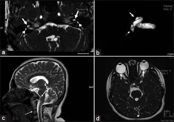27-year-old female with poor vision and inability to hear was subsequently diagnosed with CHARGE syndrome. (a) Axial Constructive Interference in Steady State (CISS) T2-weighted MRI at the level of internal auditory meatus shows bilateral hypoplasia of semicircular canals seen as small saccular structures instead of normal “D” like canalicular structure (small arrows) and cochlea shows only one and half (11/2) turns instead of normal two and half (21/2) or more (large arrows). (b) Three-dimensional reconstruction of CISS MRI images of the right internal auditory apparatus confirming rudimentary semicircular canals (small arrow) and hypoplasia of cochlea (large arrow). (c) T2 Fast spin echo mid-sagittal reconstruction of MRI head shows associated craniovertebral junction anomaly with fused C2 and C3 vertebrae with rudimentary intervertebral disc (dotted arrow) and basilar invagination (solid arrow). (d) Axial CISS T2 weighted MRI at the level of orbits shows defects of choroid (solid arrows).