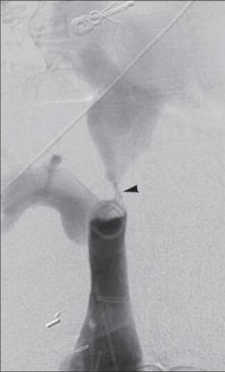 36-year-old woman with a history of autoimmune hepatitis and two prior orthotopic liver transplants who presented 5 years after her most recent transplant with a chief complaint of progressive bilateral lower extremity edema and weight gain was diagnosed with transplant-related, initially angioplasty-resistant IVC stenosis. Inferior vena cavagram reveals high-grade stenosis of hepatic level IVC (arrowhead), with 2-3 mm luminal caliber at this site.