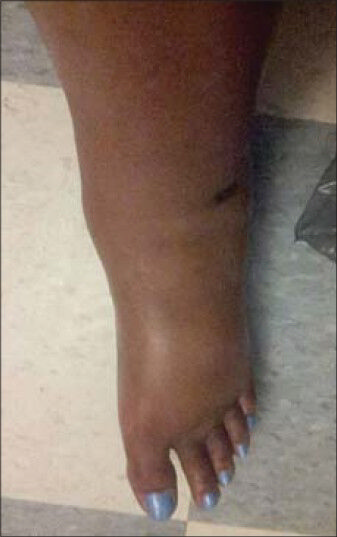 36-year-old woman with a history of autoimmune hepatitis and two prior orthotopic liver transplants who presented 5 years after her most recent transplant with a chief complaint of progressive bilateral lower extremity edema and weight gain was diagnosed with transplant-related, initially angioplasty-resistant IVC stenosis. Pre-treatment photograph shows marked lower extremity edema.