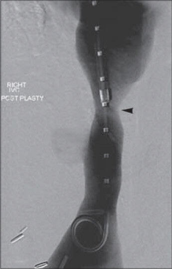 36-year-old woman with a history of autoimmune hepatitis and two prior orthotopic liver transplants who presented 5 years after her most recent transplant with a chief complaint of progressive bilateral lower extremity edema and weight gain was diagnosed with transplant-related, initially angioplasty-resistant IVC stenosis. Inferior vena cavagram performed following multiple venoplasty sessions reveals excellent response to therapy, with luminal diameter enlargement to 10-11 mm (arrowhead).