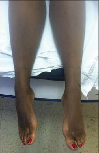 36-year-old woman with a history of autoimmune hepatitis and two prior orthotopic liver transplants who presented 5 years after her most recent transplant with a chief complaint of progressive bilateral lower extremity edema and weight gain was diagnosed with transplant-related, initially angioplasty-resistant IVC stenosis. Post-treatment photograph demonstrates complete resolution of lower extremity edema.