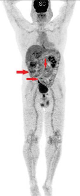 69-year-old male with blood in the urine was diagnosed with chromophobe renal cell carcinoma. Maximum intensity projection (MIP) image shows omental deposits from chromophobe renal cell carcinoma (arrows).