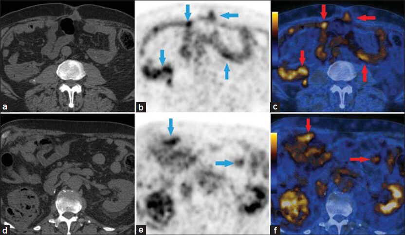 69-year-old male with blood in the urine was diagnosed with chromophobe renal cell carcinoma. (a) Axial CT image for attenuation correction and anatomic localization, (b and c) Axial PET/CT images show scattered focal areas of increased FDG avidity in the cecal wall and small bowel (arrows). This was consistent with serosal implants from chromophobe renal cell carcinoma, (d) Axial CT image for attenuation correction and anatomic localization, and (e and f) Axial PET/CT images show omental nodular deposits in the mid abdomen (arrows). The SUVmax was 4.6.