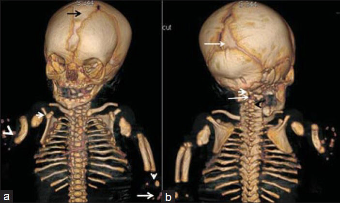 Fetus at 35 weeks of gestation diagnosed with Grebe syndrome. Reconstruction skeletal CT scan a) Anterior view shows markedly opened anterior fontanel (black arrow), defective development of the shoulder girdle, dysplastic lateral parts of the clavicles, aplasia of the glenoids (white arrow), marked tilting of the scapulae, rudimentary humeri, aplasia of the radius on the right side (radial club hand and dislocation) (white arrowhead), and dysplastic radius and ulna of the left forearm associated with severe defective ossification of the carpals (vertical white arrow), though ossification of the distal phalanges of three digits is evident to a certain extent (long white arrow). b) Posterior view shows markedly opened posterior fontanel (long white arrow), ill-defined cranio-cervical junction (short white arrow), and no anatomical landmark of the odontoid (long white arrow), associated with fusion of the posterior arches of C3-C4 (black arrowhead).