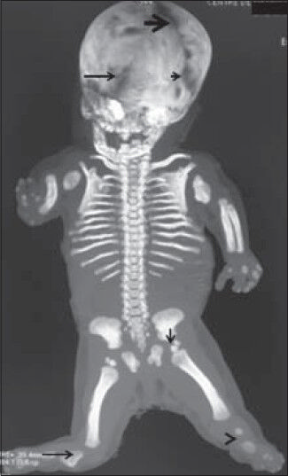 Fetus at 35 weeks of gestation diagnosed with Grebe syndrome. Skeletal 3DCT scan confirms large skull and massive ossification defects along the anterior fontanel (black thick arrow), severe gap along the coronal suture (short black arrow) and another massive gap (defective ossification) along the metopic suture (long black arrow). The ischium appears markedly dysplastic and is associated with double ossification of the capital femoral epiphyses (vertical black arrow) (severe dysplasia of the pelvic girdle), aplasia of the left tibia and fibula (black arrowhead) and presence of a rudimentary right tibia (long black arrow).