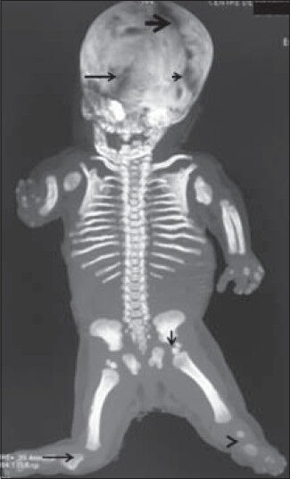 Achondroplasia Dwarfism Skeleton