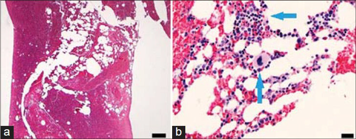 56-year-old male with a complaint of difficulty in urinating was diagnosed with prostate cancer. (a) Low power view of the marrow biopsy (×20) shows no abnormalities. Scale bar = 200 microns (b) High power view of the biopsy sample (×200) shows normal hematopoietic cells, including megakaryocytes, visible within the adipose tissue of bone marrow (arrows). Scale bar = 20 microns. No metastasis of the prostate cancer WAS observed. Was = past tense.