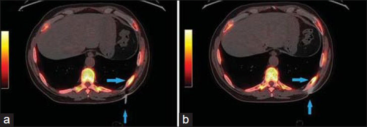 56-year-old male with a complaint of difficulty in urinating was diagnosed with prostate cancer. Axial PET/CT images (a) Increased FDG uptake in the left 8th rib (arrows) and (b) 12 cm Jamshidi bone biopsy needle (arrows) in the metabolically active region of the left 8th rib.