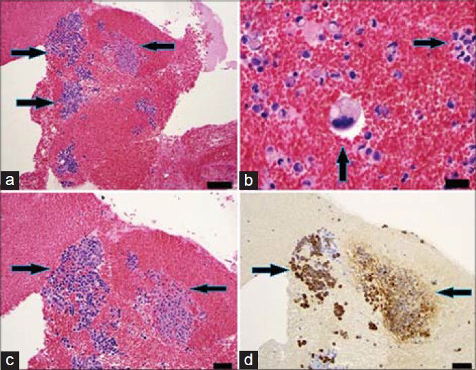 83-year-old male with elevated prostate-specific antigen (PSA) was diagnosed with prostate cancer. (a) Low power view of FNA cell block material (×10) shows abundant tumor tissue (arrows). Scale bar = 100 microns (b) High power view (×100) of an area of dyshesive neoplastic cells demonstrates esophageal adenocarcinoma of signet ring cell morphology. Signet ring morphology is described as abundant in cytoplasm with the nucleus pushed to one side (arrows) Scale bar = 20 microns (c) Hematoxylin and eosin stained sample (×50) shows clusters of neoplastic cells (arrows) and (d) immunohistochemical staining of the sample shows cells positive for pancytokeratin (arrows) (d). Scale bars = 50 microns.