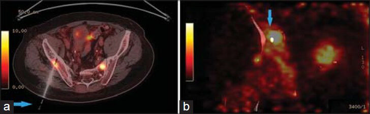 83-year-old male with elevated prostate-specific antigen (PSA) was diagnosed with prostate cancer. Axial PET/CT image shows high FDG uptake in the right iliac bone. (a) Hybrid PET/CT guided the needle (arrow) to the exact location of the hypermetabolic lesion in the right iliac bone (b) The tip of the needle (arrow) in the lesion suspected for metastasis.