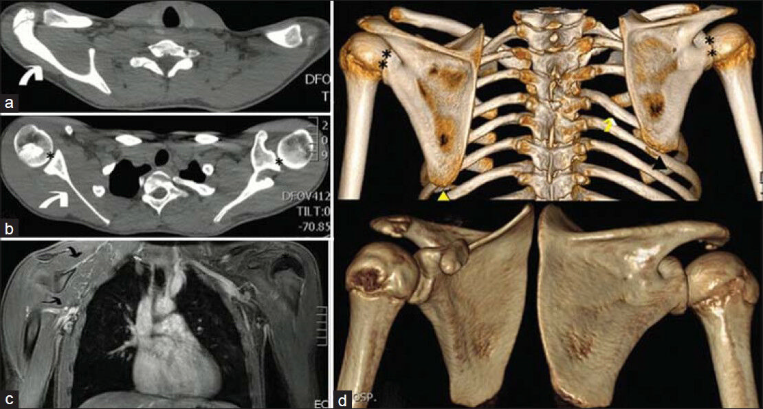 Case 3. 14-year-old boy with a right-sided nuchal deformity, shown with CT and MRI to be a Sprengel scapula. (a and b) Axial CT-scan images demonstrate the elevated position of the right scapula (white arrows). The shoulder joints (asterisks) are asymmetrical. (c) Coronal MRI reveals mildly hypoplastic musculature of the right shoulder (double arrow). (d) 3D-CT reconstruction images show that the right scapula (black arrowhead) is higher than the left (yellow arrowhead). Note the associated deformity of the rib cage on the right side (yellow arrow) and the asymmetry of the shoulder joints (double asterisks).