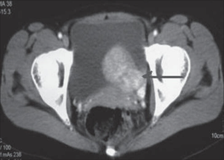 26-year-old female with accelerated hypertension and elevated serum metanephrines diagnosed with pelvic paraganglioma. CECT abdomen axial cut shows heterogeneously enhancing intraluminal growth (arrow) from the left anterolateral wall of the urinary bladder with predominant intraluminal component.