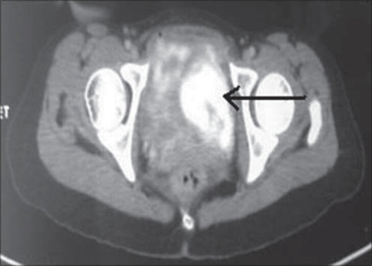 26-year-old female with accelerated hypertension and elevated serum metanephrines diagnosed with pelvic paraganglioma. PET/CT image shows intense tracer uptake and somatostatin receptor expressing lesion (arrow) in the left lateral wall of the urinary bladder.