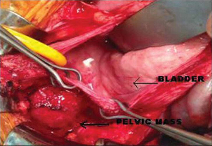 26-year-old female with accelerated hypertension and elevated serum metanephrines diagnosed with pelvic paraganglioma. Intraoperative image shows tumor arising from the left lateral pelvic wall (arrow) and the bladder appears normal (thin arrow).