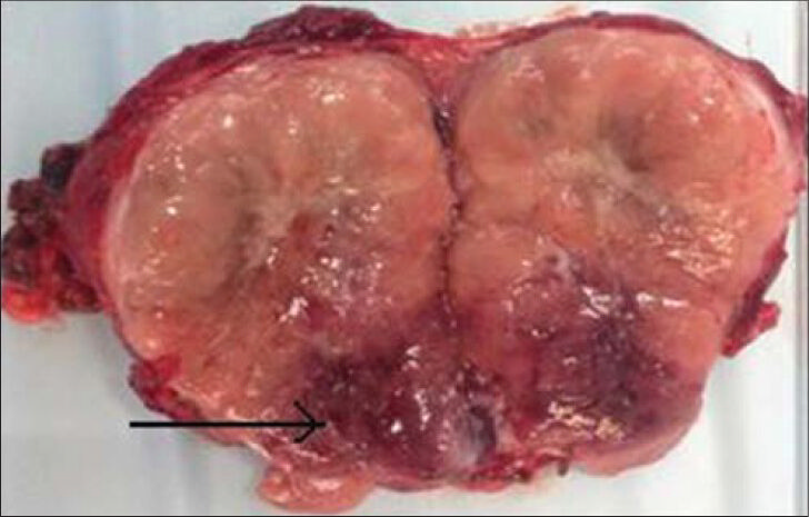 26-year-old female with accelerated hypertension and elevated serum metanephrines diagnosed with pelvic paraganglioma. Photograph of the cut specimen of the excised mass shows areas of necrosis in its inferior aspect (arrow).
