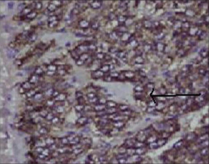 26-year-old female with accelerated hypertension and elevated serum metanephrines diagnosed with pelvic paraganglioma. Photomicrograph of the tissue on immunohistochemical staining (×10) shows positivity for chromogranin marker, suggestive of pheochromocytoma (arrow).