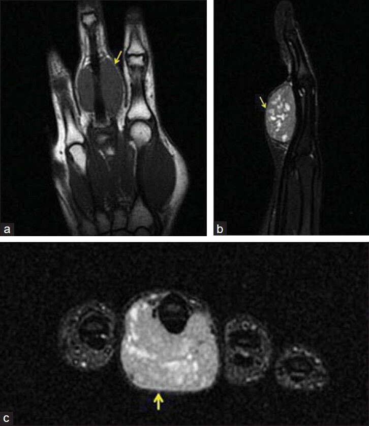 27-year-old right-hand dominant female patient with a swelling on the proximal phalanx of her right 3rd finger diagnosed as Ewing's sarcoma. (a) T1W coronal, (b) T2W sagittal, (c) T1W axial contrast enhanced images of the right hand 3rd finger, proximal phalanx palmar side, neighboring the flexor tendon, show a lesion hypointense on T1W (arrow), hyperintense on T2W (arrow), with contrast enhancement (solid arrow).