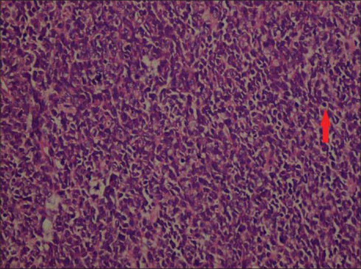 27-year-old right-hand dominant female patient with a swelling on the proximal phalanx of her right 3rd finger diagnosed as Ewing's sarcoma. Excised tissue stained with hematoxylin and eosin (×400) shows Ewing's sarcoma tumor cells in parts with clear appearance due to presence of glycogen (arrow).