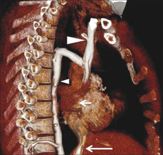 18-year-old male with complex congenial heart disease had attacks of ventricular tachycardia and oxygen saturation levels that showed discrepancy between the upper and the lower extremities, later diagnosed with a rare collateral vein draining from the left subclavian vein to the great cardiac vein. Three-dimensional MDCT of the heart and thorax demonstrates extraordinary dilated azygous vein (small arrowhead) draining into the superior vena cava (large arrow head), and the inferior vena cava (large arrow) draining directly into the right atrium (small arrow).