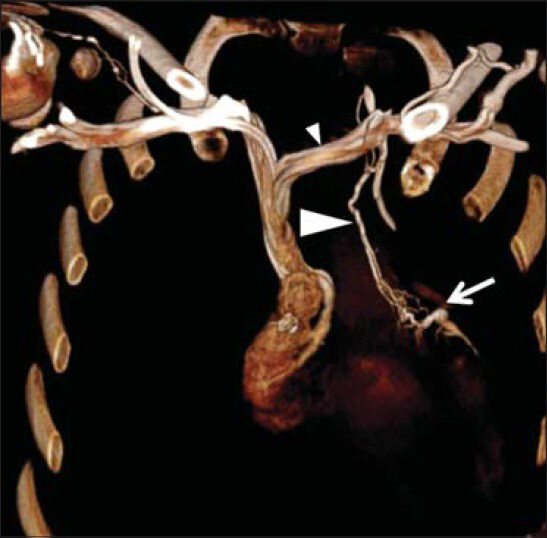 18-year-old male with complex congenial heart disease had attacks of ventricular tachycardia and oxygen saturation levels that showed discrepancy between the upper and the lower extremities, later diagnosed with a rare collateral vein draining from the left subclavian vein to the great cardiac vein. Three-dimensional MDCT of the heart and thorax demonstrates the collateral vein (large arrowhead) from the left subclavian vein (small arrowhead) draining into the great cardiac vein (arrow).