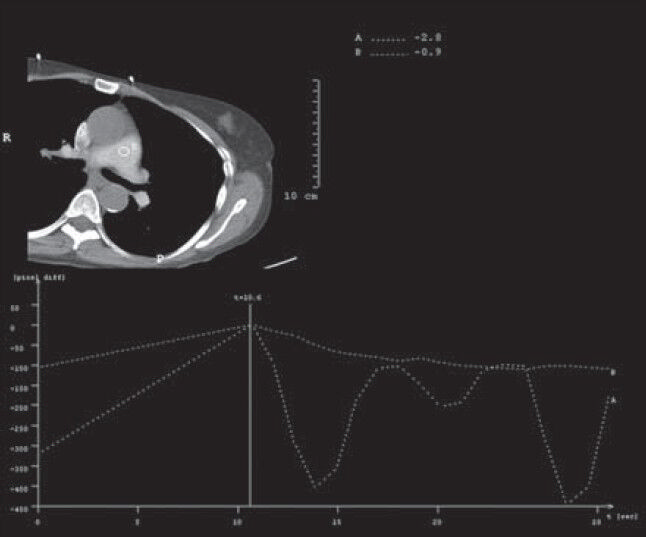 18-year-old male with complex congenial heart disease had attacks of ventricular tachycardia and oxygen saturation levels that showed discrepancy between the upper and the lower extremities, later diagnosed with a rare collateral vein draining from the left subclavian vein to the great cardiac vein. Determination of contrast bolus transit time using test bolus injection shows that the region of interest is placed inside the superior vena cava (circle A) and in the pulmonary trunk (circle B). Resulting enhancement curves display the time needed to reach the peak of maximum contrast enhancement for test bolus.