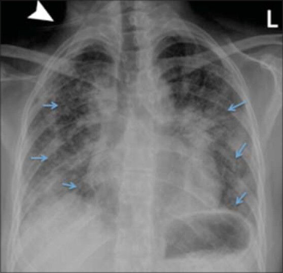 38-year-old female with a known history of Hermansky–Pudlak syndrome complicated by pulmonary fibrosis, admitted with hypoxia. Posteroanterior chest radiograph performed on admission demonstrates bilateral, mid to lower lung predominant, diffuse reticular interstitial opacities (arrows). Tubing from oxygen cannulation projects over the image (arrowhead).