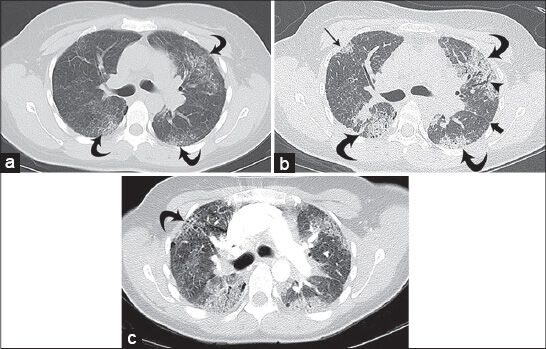 38-year-old female diagnosed with Hermansky–Pudlak syndrome complicated by pulmonary fibrosis, as evidenced by worsening dyspnea, cough, and increasing oxygen dependence. Baseline high-resolution CT (HRCT) of the chest: (a) Axial image on lung windows at the level of the carina demonstrates scattered, predominantly peripheral, ground glass opacities with associated fine peripheral reticulation in the lungs bilaterally (curved arrows); (b) high-resolution CT of the chest from the same level obtained 13 months later demonstrates progression of the peripheral opacities that have become more consolidative (curved arrows) with more conspicuous subpleural opacity in the right upper lobe (straight thin arrow); there is new bronchiectasis (arrowhead) and septal thickening along the left main fissure (thick arrow); and (c) axial CT of the chest on lung windows at terminal admission, performed as part of a CT pulmonary angiogram protocol (16 months after initial imaging), demonstrates further progression with increased size of peripheral consolidative opacities and increasing bronchiectasis. There is new honeycombing in the upper lobes bilaterally (curved arrow). Of note, the study did not demonstrate a pulmonary embolus.