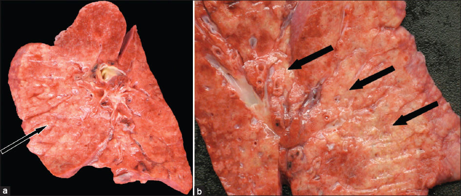 38-year-old female with history of Hermansky–Pudlak syndrome and end -stage pulmonary fibrosis, admitted with hypoxia and was terminally extubated after sustaining multiorgan failure. Postmortem autopsy was performed. (a and b) Photographs of coronal cut sections of a lung demonstrate diffuse nodular parenchymal fibrosis (arrows) with apparent bronchiolocentric distribution.