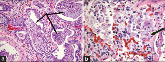 38-year-old female with history of Hermansky–Pudlak syndrome and end-stage pulmonary fibrosis, admitted with hypoxia. Photomicrographs of postmortem microscopic examination of lung tissue stained with hematoxylin–eosin stain: (a) ×200 magnification demonstrates end-stage remodeling, with honeycomb cystic spaces lined by metaplastic bronchial epithelium and surrounded by well-developed fibrosis (arrows); (b) ×400 magnification shows alveolar septal thickening associated with prominent diffuse vacuolization of type II pneumocytes (arrow).