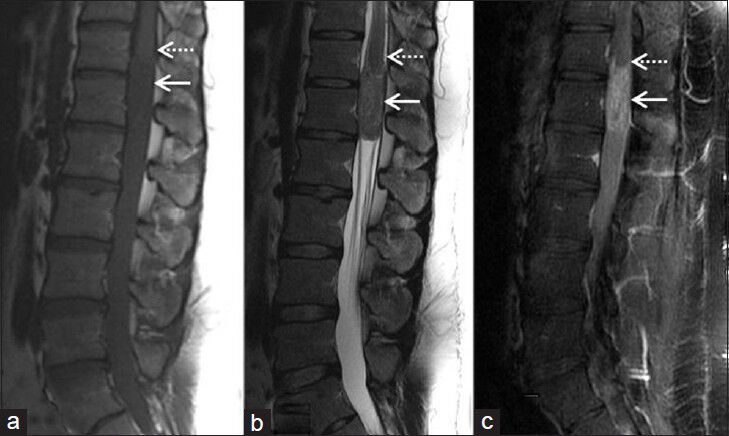 Case 1. 26-year-old male with low back pain diagnosed with Ewing's sarcoma/peripheral neuroectodermal tumor. (a) Magnetic resonance imaging (MRI) sagittal T1 WI image shows a hypointense intradural mass lesion (solid arrow) at the level of the conus medullaris (dashed arrow), (b) MRI Sagittal T2 WI image shows the lesion (solid arrow) to be mildly hyperintense, and (c) MRI sagittal postcontrast T1 WI image shows the lesion (solid arrow) demonstrates heterogeneous enhancement after administration of contrast. The conus cannot be visualized separately from the lesion in all images (dashed arrows).