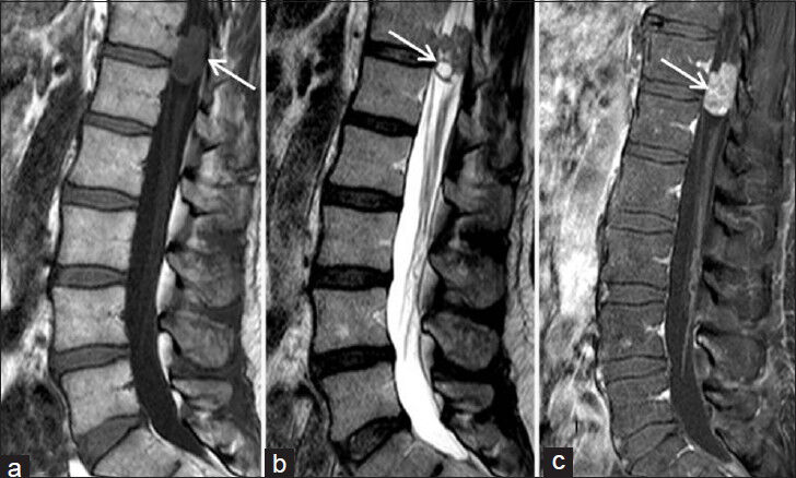 Case 2. 70-year-old male with increasing back pain diagnosed with Ewing's sarcoma/peripheral neuroectodermal tumor. (a) Magnetic resonance imaging (MRI) sagittal T1 WI image shows a hypointense intradural extramedullary mass (arrow) at the level of T12-L1, (b) MRI Sagittal T2 WI image shows a mixed signal intensity, predominantly hyperintense signal mass with a cystic component (arrow), and (c) MRI sagittal postcontrast T1 WI image demonstrates heterogeneous enhancement of the lesion (arrow).