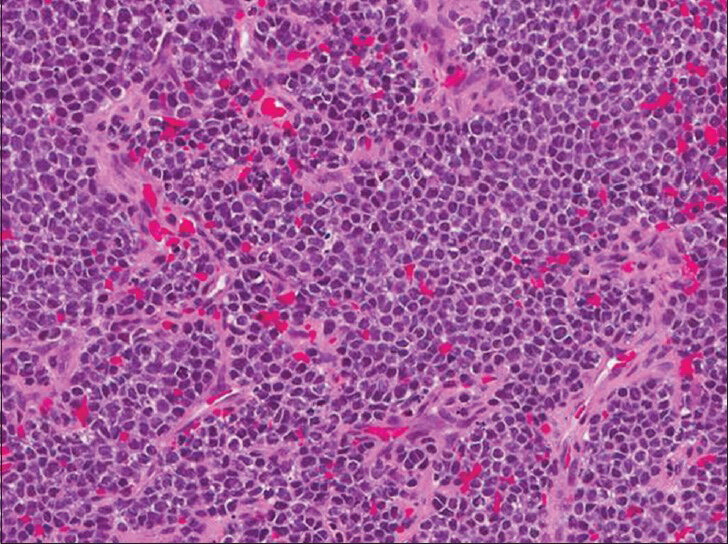 Hematoxylin and eosin stained sections of tumors from both cases (Case 2 shown here) show the classic histologic appearance of a small blue cell neoplasm with nests of small round tumor cells with scanty cytoplasm.