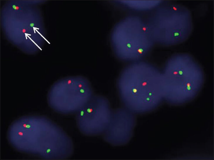 Fluorescent in situ hybridization for Ewing's sarcoma breakpoint region 1 (ESWR1) gene rearrangement performed reveals that the tumors in both cases (Case 2 shown here) are positive for EWSR1 gene rearrangement as indicated by the separation of red and green signals (arrows).