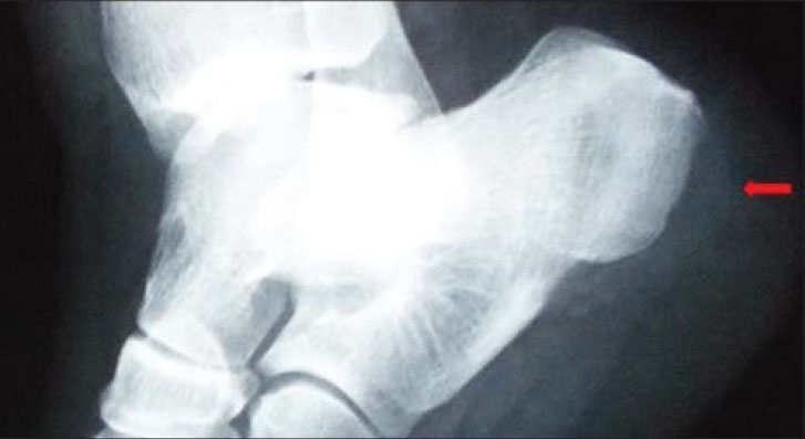17-year-old female with pain in the left heel diagnosed as due to an aneurysmal bone cyst. Lateral X-ray of the left foot shows radiolucent lesion (arrow) leading to expansion on the postero-lateral part of the calcaneus.