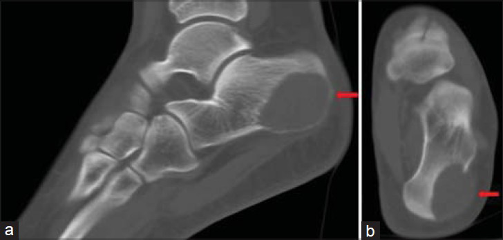 Aneurysmal Bone Cyst of the Calcaneus - Journal of Clinical Imaging Science