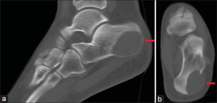 17-year-old female with pain in the left heel diagnosed as due to an aneurysmal bone cyst. CT scans of the left foot a) sagittal and b) coronal views show lytic mass lesion (arrow), 35 × 25 mm in dimension, localized postero-laterally, leading to cortical bone erosion, expansion, and destruction.