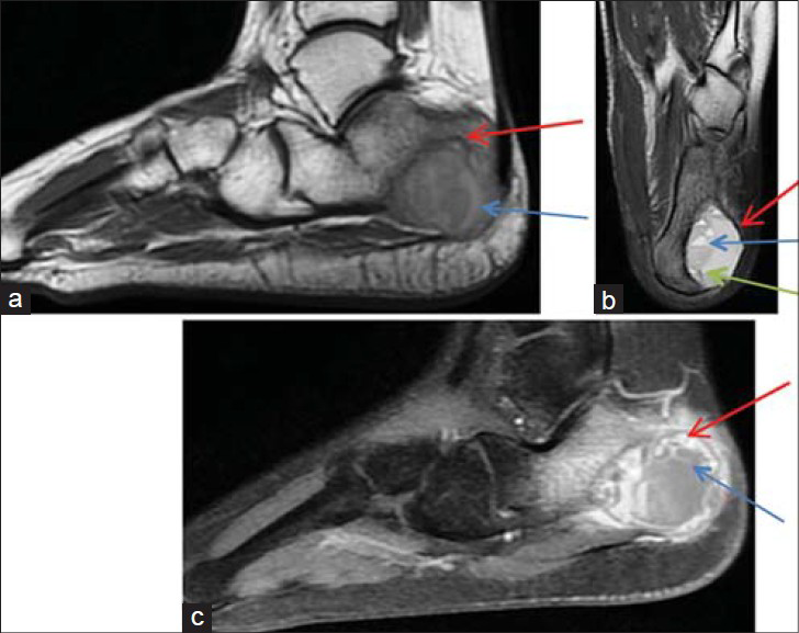 17-year-old female with pain in the left heel diagnosed due an aneurysmal bone cyst. MRI on the postero-lateral part of the calcaneus shows a cystic mass lesion in the medullary cavity. a) T1W and b) T2W sequences show heterogeneous hyperintense sclerotic rim (red arrow) surrounding the medullar component and central heterogeneous hyperintense septae formations (green arrow). T2W sequence shows blood level components (blue arrow). c) Image following intravenous contrast media administration shows contrast enhancement surrounding the lesion (red arrow) and in the septae formations (blue arrow).