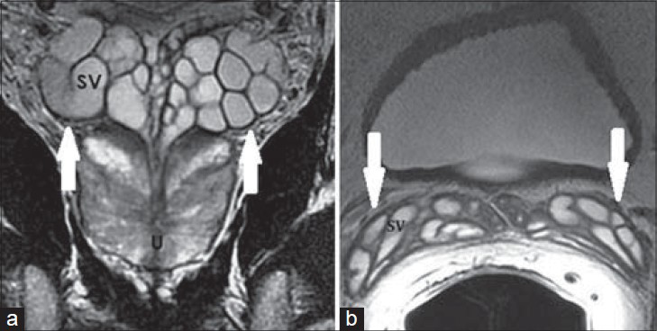 41-year-old asymptomatic male. a) Coronal and b) axial T2-weighted MR images show clustered grape-like appearance of the SVs (white arrows) with high T2 signal intensity of internal content and low T2 signal intensity of the wall of normal SVs.