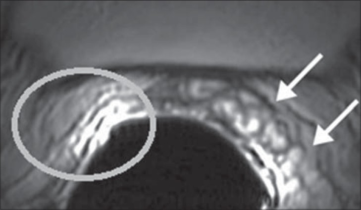 34-year-old male with infertility diagnosed to have hypospermia. Axial T2-weighted MR image using an endorectal coil shows a normal left SV (white arrows) and none on the right (white circle).