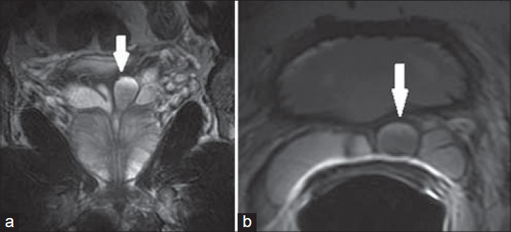 58-year-old male with rising PSA levels presented for a prostate MRI. a) Coronal and b) axial T2-weighted MR images show a cyst within the left SV (white arrow), which is non-specific and can be congenital or secondary to other inflammatory etiologies.