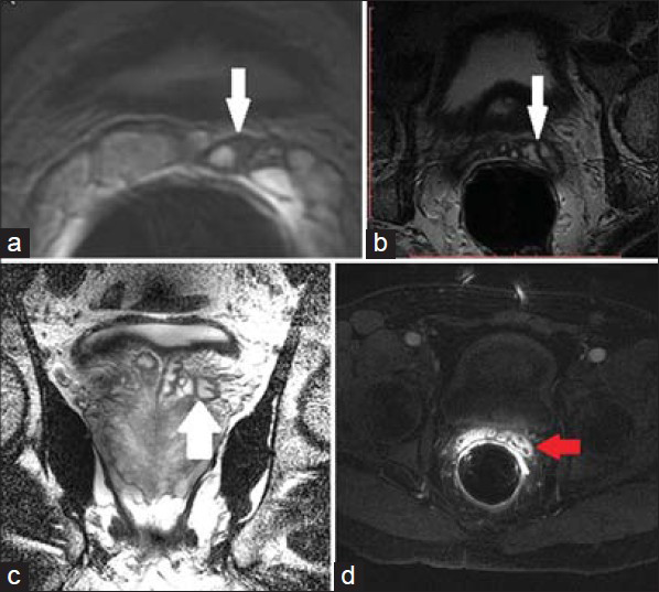 24 year old male with 3 week history of residual pain after treatment for gonococcal infection. a) Axial T2 weighted MRI through the SV shows mild asymmetric dilation of the left SV with focal areas of wall thickening (white arrow). These findings are commonly seen with seminal vesiculitis, although the etiology is non-specific. 53-year-old male presented with acute prostatitis. b) Axial and c) coronal T2-weighted MR images show more diffuse thickening of the SV wall (white arrow). d) Post contrast image shows enhancement (red arrow). These findings are characteristic of seminal vesiculitis.