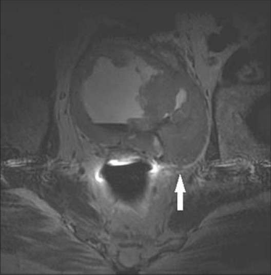 66-year-old male presented with hematuria and was diagnosed with sarcoma of the left SV. Axial T2-weighted MRI of the left SV demonstrates a large low T2 signal infiltrative mass with invasion of the bladder base. On histologic evaluation, the mass was found to be a sarcoma originating from the left SV.