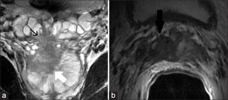 56-year-old male with an elevated PSA diagnosed with prostatic adenocarcinoma. a) Coronal and b) axial T2-weighted MR images demonstrate a prostatic mass at the right base (white arrow) extending through the capsule into the right SV (black arrow). Findings are consistent with prostatic adenocarcinoma with invasion of the right SV.