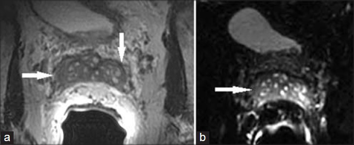 76-year-old with elevated PSA presented for initial prostate MRI. (a) Axial T2 MR image and b) axial diffusion-weighted image of the SV demonstrate diffusely thickened SV wall and luminal narrowing. Lack of diffusion restriction helped exclude tumor and lack of contrast enhancement helped exclude seminal vesiculitis. These changes were found to be secondary to amyloidosis.