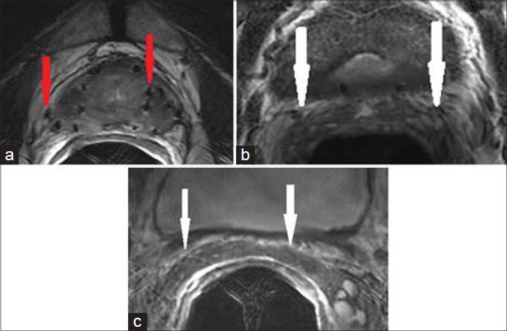 69-year-old male with history of treated prostate carcinoma presented for a follow-up study. a) Axial and b) coronal T2-weighted MR images through the pelvis show scattered foci of susceptibility, consistent with radiation seeds. The SVs are diffusely atrophied with low T2 signal, consistent with radiation fibrosis.