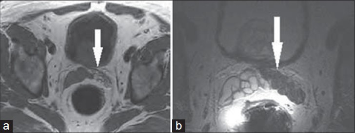 71-year-old male with rising PSA presented for a prostate MRI 2 weeks after prostate biopsy. a) Axial T1-weighted and b) axial T2-weighted MRI of the left SV show low T2 and high T1 signal throughout the left SV (white arrow), consistent with hemorrhage.